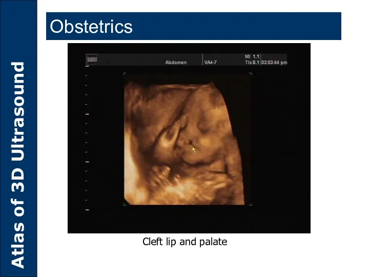 Cleft lip and palate Obstetrics