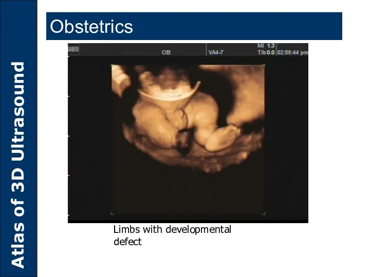 Limbs with developmental defect Obstetrics