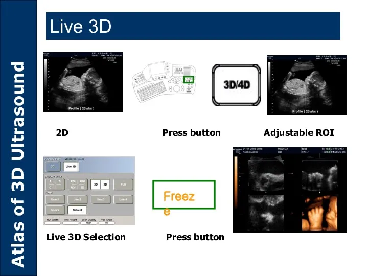 Freeze 2D Press button Adjustable ROI Live 3D Selection Press button Live 3D