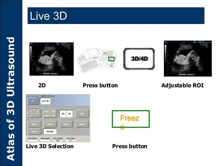 2D Press button Adjustable ROI Live 3D Selection Press button Freeze Live 3D