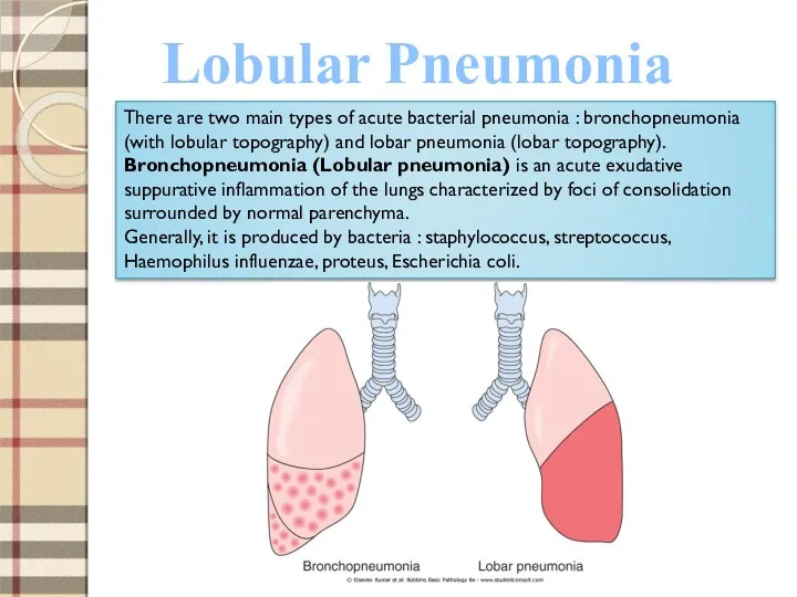 Lobular Pneumonia There are two main types of acute bacterial pneumonia : bronchopneumonia