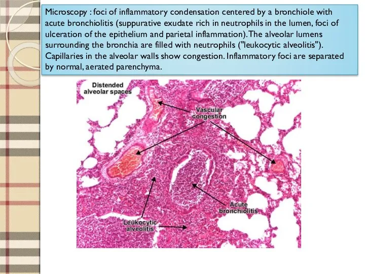 Microscopy : foci of inflammatory condensation centered by a bronchiole with acute bronchiolitis