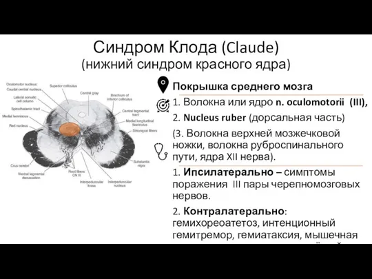 Покрышка среднего мозга 1. Волокна или ядро n. oculomotorii (III), 2. Nucleus ruber