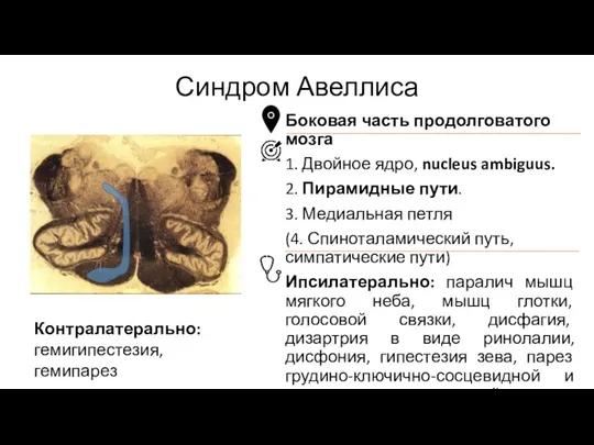 Синдром Авеллиса Боковая часть продолговатого мозга 1. Двойное ядро, nucleus ambiguus. 2. Пирамидные