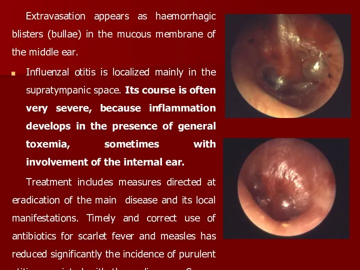 Extravasation appears as haemorrhagic blisters (bullae) in the mucous membrane