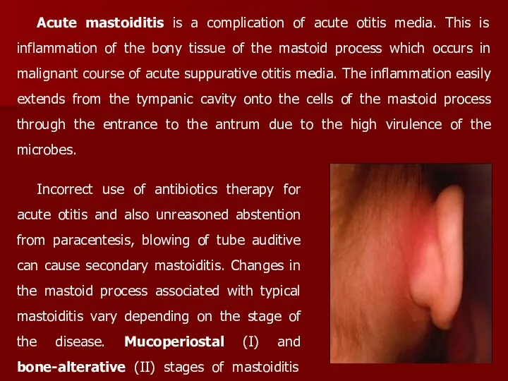 Acute mastoiditis is a complication of acute otitis media. This