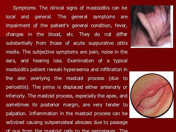 Symptoms. The clinical signs of mastoiditis can be local and