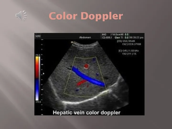 Color Doppler