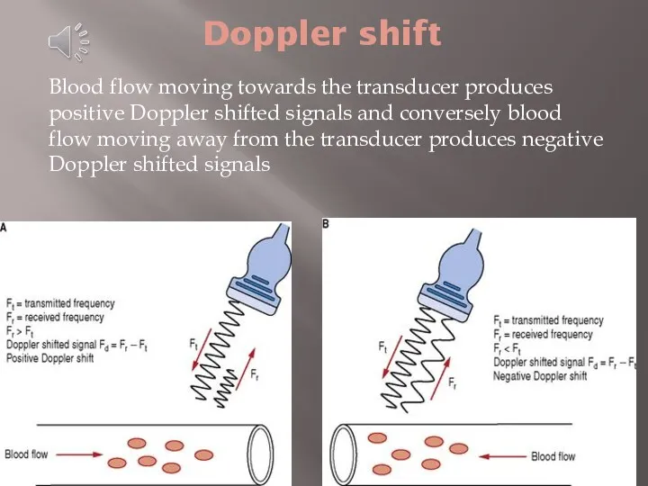 Doppler shift Blood flow moving towards the transducer produces positive