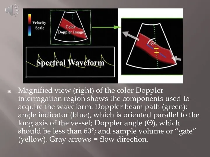 Magnified view (right) of the color Doppler interrogation region shows