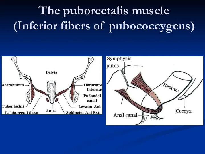 The puborectalis muscle (Inferior fibers of pubococcygeus)