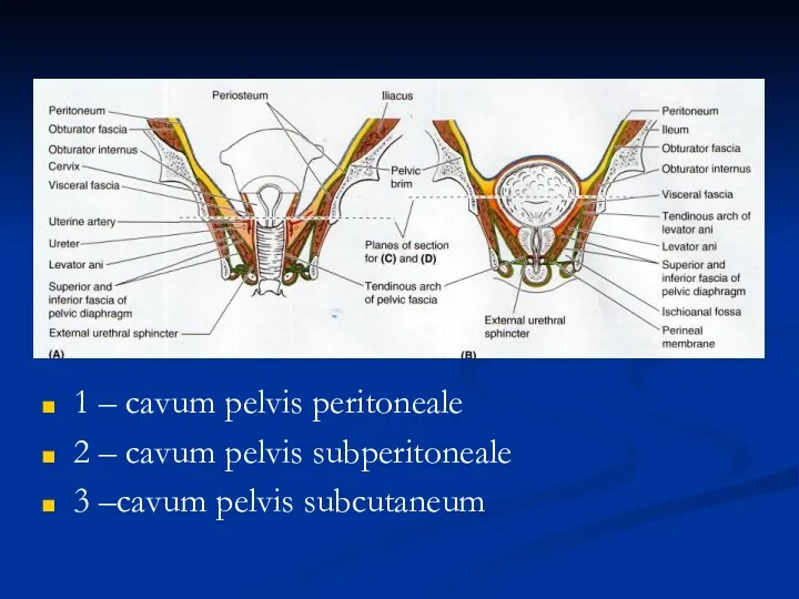 1 – cavum pelvis peritoneale 2 – cavum pelvis subperitoneale 3 –cavum pelvis subcutaneum
