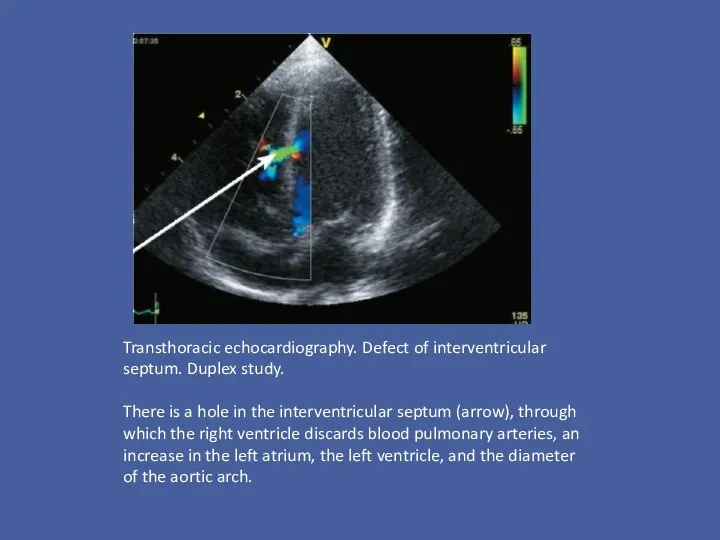 Transthoracic echocardiography. Defect of interventricular septum. Duplex study. There is