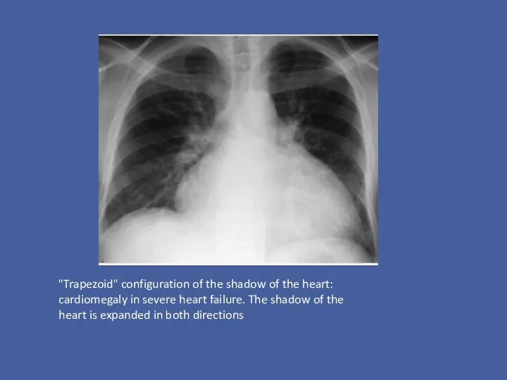 "Trapezoid" configuration of the shadow of the heart: cardiomegaly in