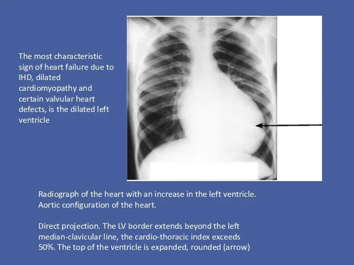 Radiograph of the heart with an increase in the left