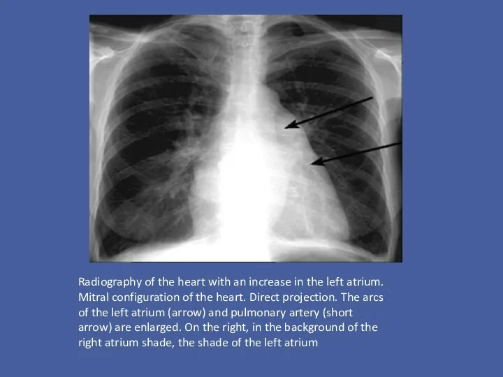 Radiography of the heart with an increase in the left