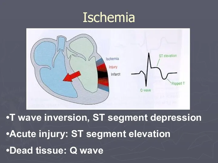 Ischemia T wave inversion, ST segment depression Acute injury: ST segment elevation Dead tissue: Q wave
