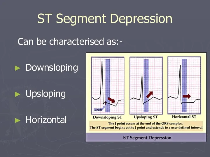 ST Segment Depression Can be characterised as:- Downsloping Upsloping Horizontal