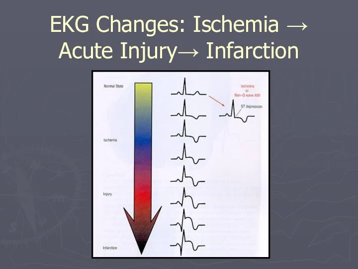 EKG Changes: Ischemia → Acute Injury→ Infarction