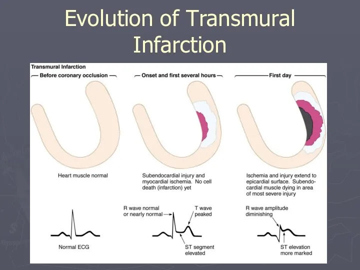 Evolution of Transmural Infarction