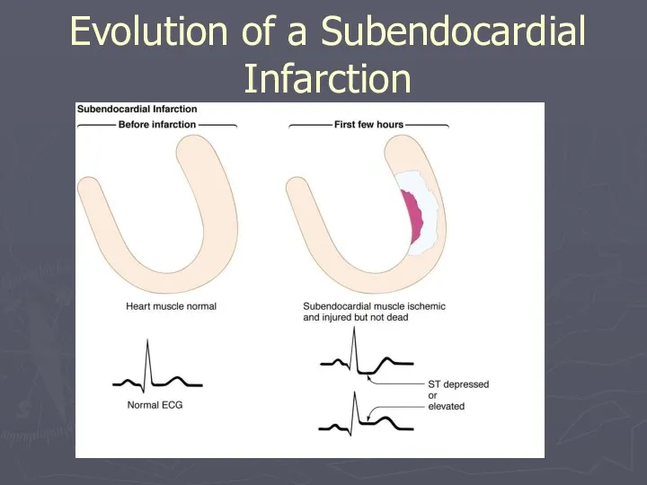 Evolution of a Subendocardial Infarction