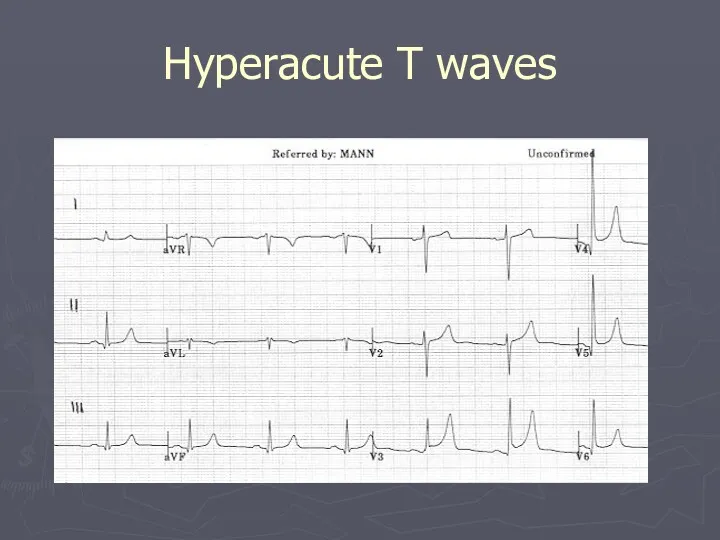 Hyperacute T waves