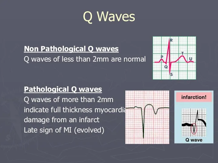 Q Waves Non Pathological Q waves Q waves of less