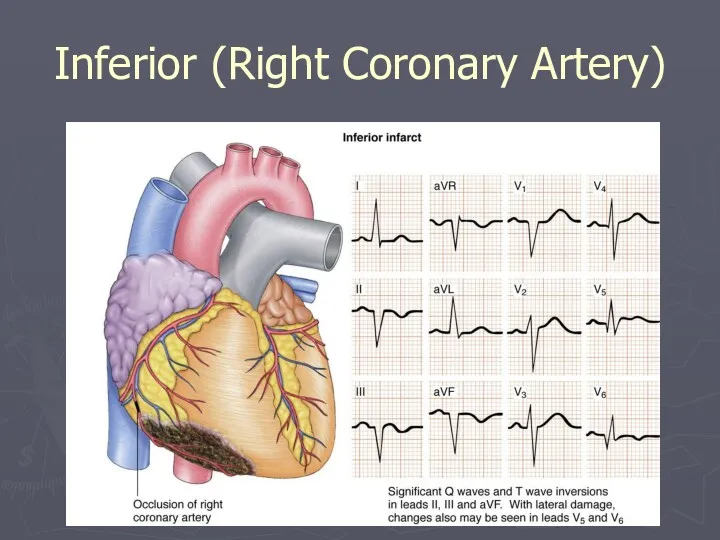 Inferior (Right Coronary Artery)