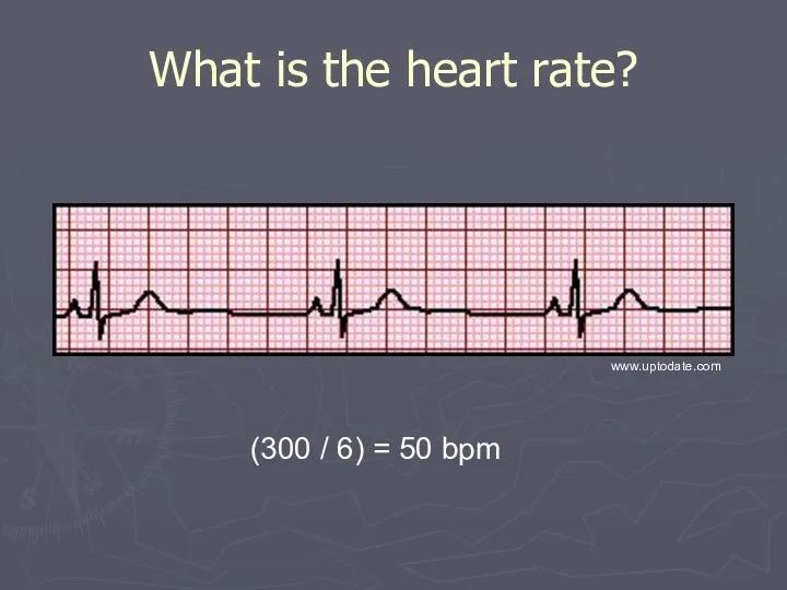 What is the heart rate? (300 / 6) = 50 bpm www.uptodate.com