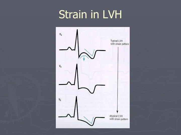 Strain in LVH