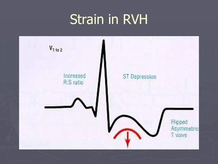 Strain in RVH