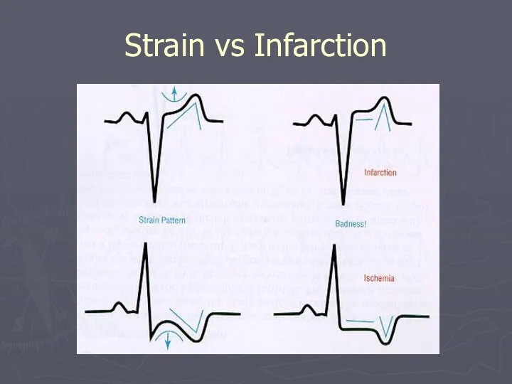 Strain vs Infarction