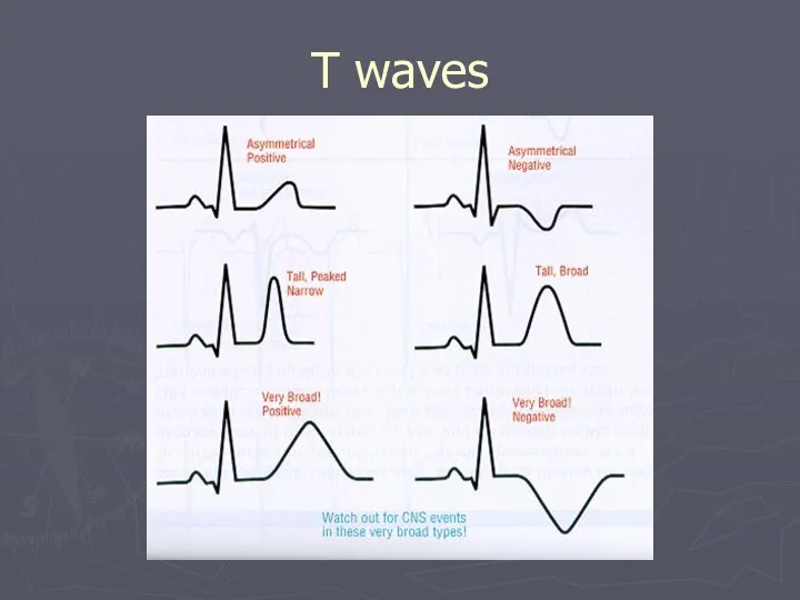 T waves