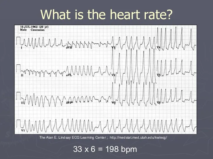 What is the heart rate? 33 x 6 = 198