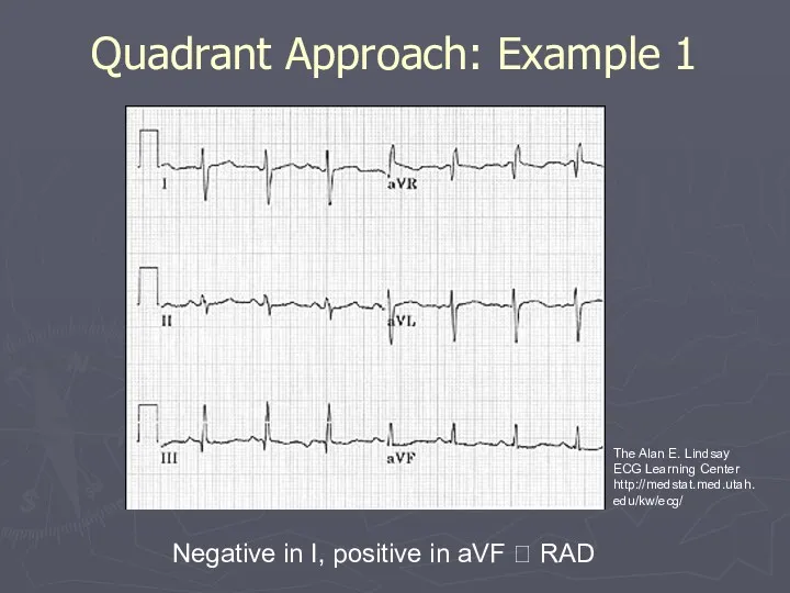 Quadrant Approach: Example 1 Negative in I, positive in aVF