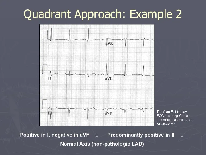 Quadrant Approach: Example 2 Positive in I, negative in aVF