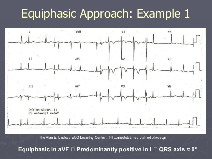 Equiphasic Approach: Example 1 Equiphasic in aVF ? Predominantly positive