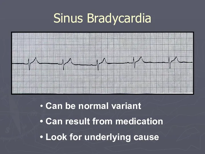 Sinus Bradycardia Can be normal variant Can result from medication Look for underlying cause