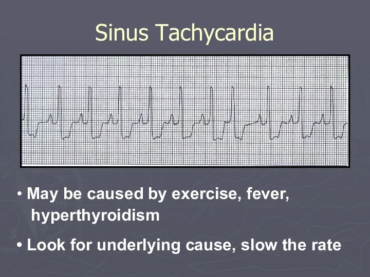 Sinus Tachycardia May be caused by exercise, fever, hyperthyroidism Look for underlying cause, slow the rate