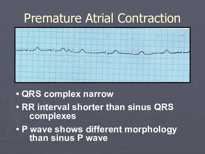 Premature Atrial Contraction QRS complex narrow RR interval shorter than