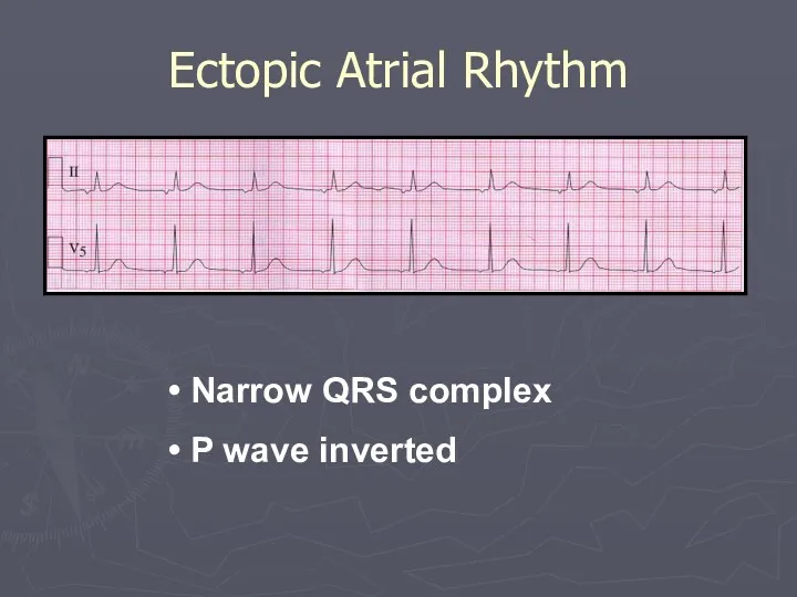 Ectopic Atrial Rhythm Narrow QRS complex P wave inverted