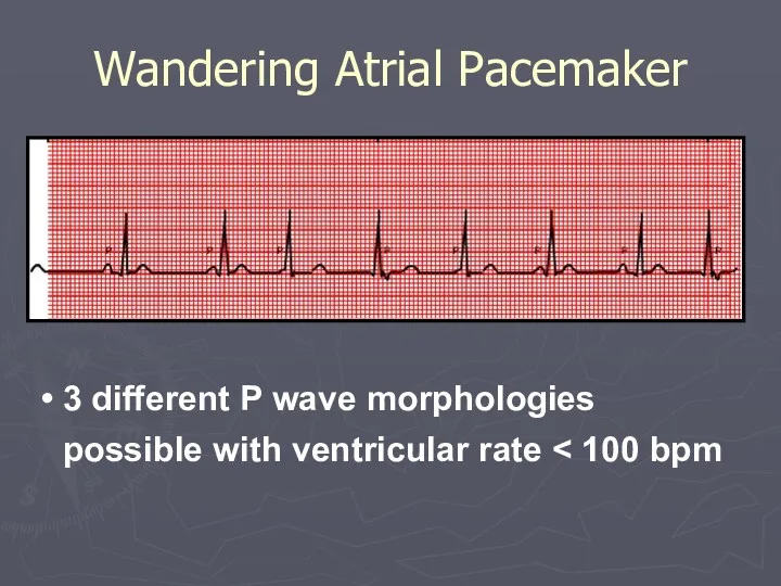 Wandering Atrial Pacemaker 3 different P wave morphologies possible with ventricular rate