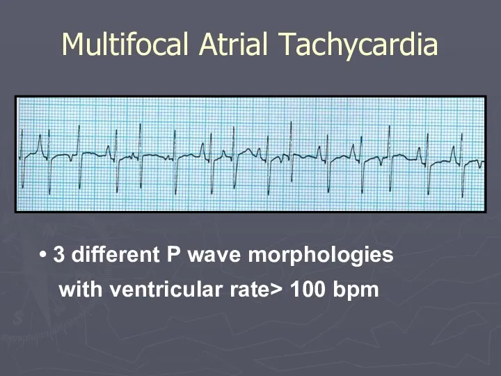 Multifocal Atrial Tachycardia 3 different P wave morphologies with ventricular rate> 100 bpm