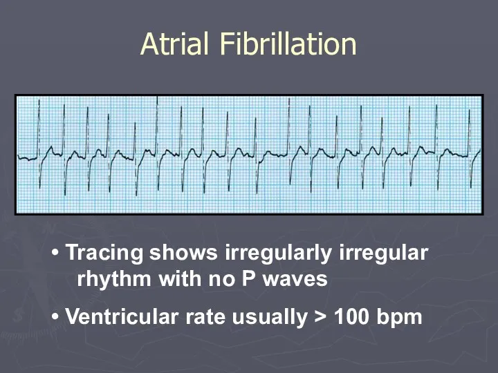 Atrial Fibrillation Tracing shows irregularly irregular rhythm with no P