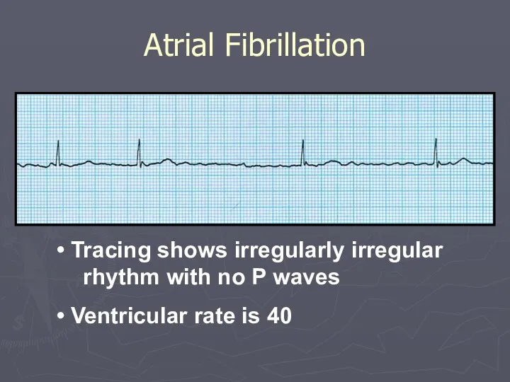 Atrial Fibrillation Tracing shows irregularly irregular rhythm with no P waves Ventricular rate is 40