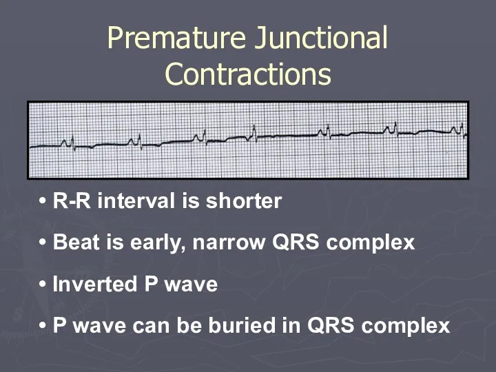 Premature Junctional Contractions R-R interval is shorter Beat is early,