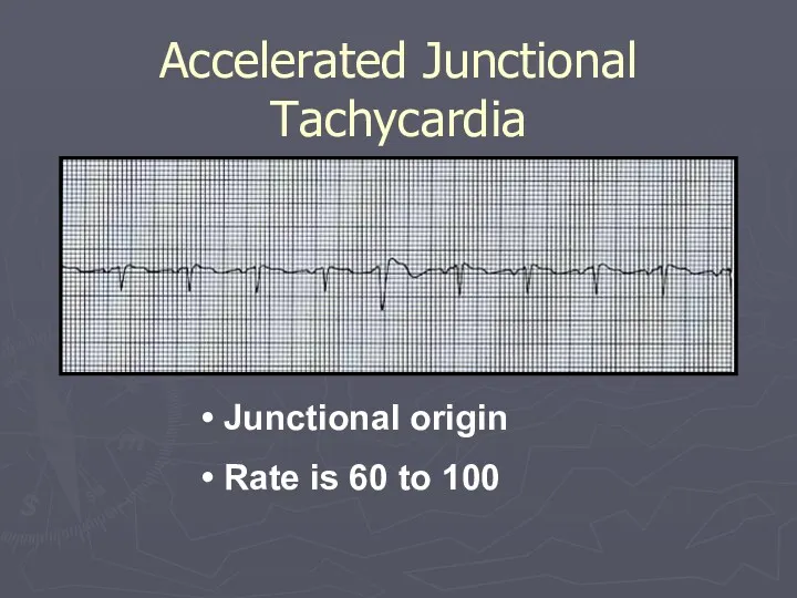 Accelerated Junctional Tachycardia Junctional origin Rate is 60 to 100