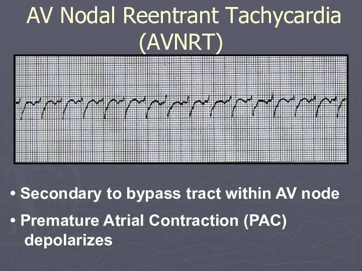 Secondary to bypass tract within AV node Premature Atrial Contraction