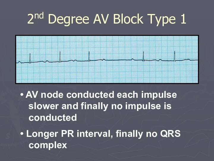 2nd Degree AV Block Type 1 AV node conducted each