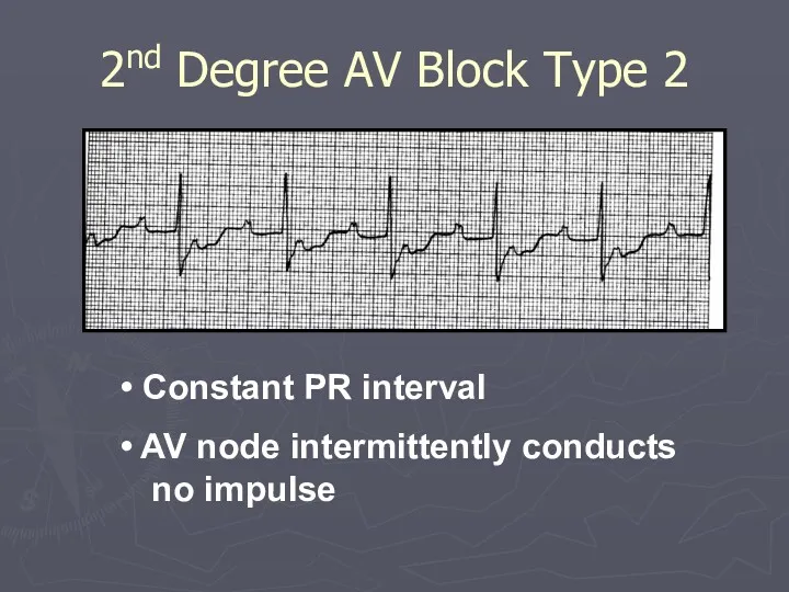 2nd Degree AV Block Type 2 Constant PR interval AV node intermittently conducts no impulse